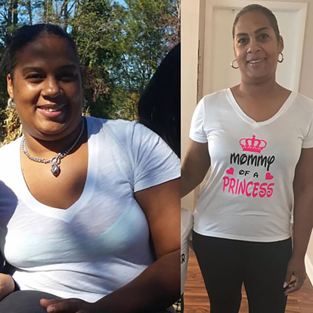 South Florida LapBand Weight Loss Surgery & Surgeons, Miami Laparoscopic Gastric Banding